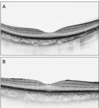 Figure 2. Scatter plots and regression line of the choroidal  thickness against axial length