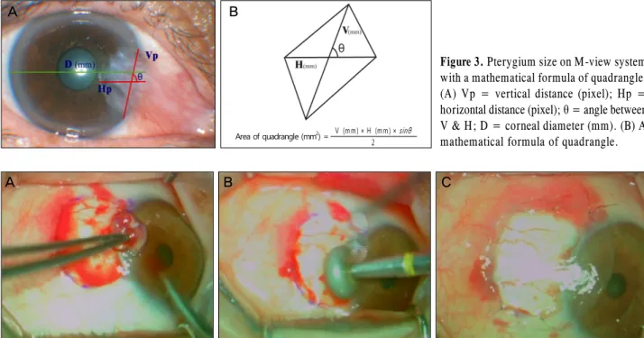 Table 2. Preoperative size of pterygium