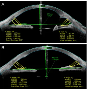 Figure 1. Anterior segment optical coherence tomography  (Visante OCT) images show implanted intraocular lens (IOL)  in the sulcus (A) and in the bag (B)