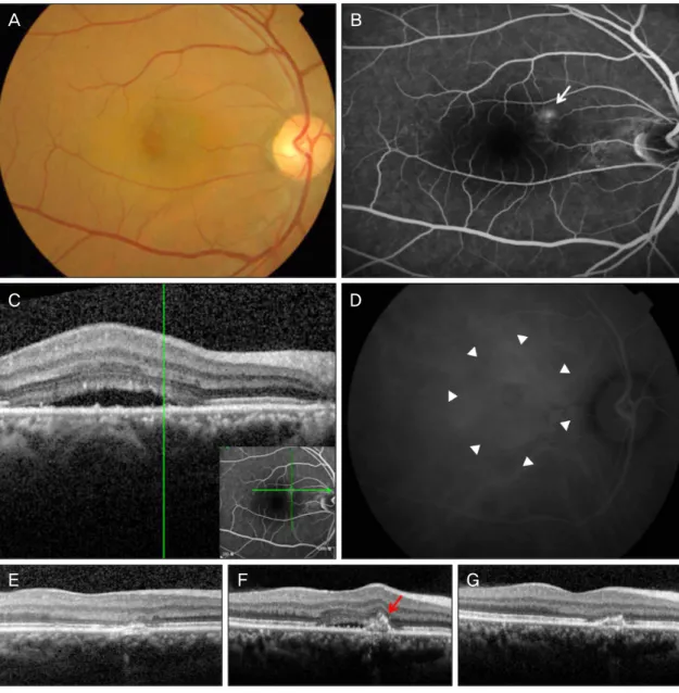 Figure 1. Fundus photograph, fluorescein angiography (FA), spectral domain optical coherence tomography (SD  OCT), and indocyanine green angiography (ICGA) images of a 53-year-old man (patient 1)