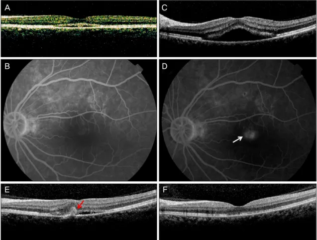 Figure 2. FA and OCT images of a 45-year-old woman (patient 2). (A) Time domain optical coherence tomography  (TD OCT) at the first examination revealed subretinal fluid