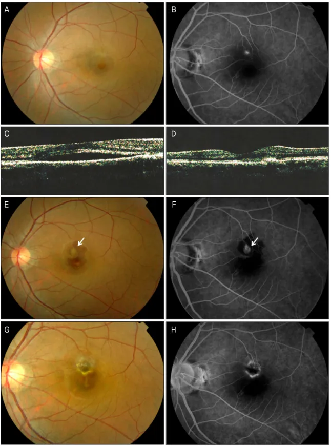Figure 4. Fundus photograph, FA, and TD OCT images of a 34-year-old woman (patient 4)