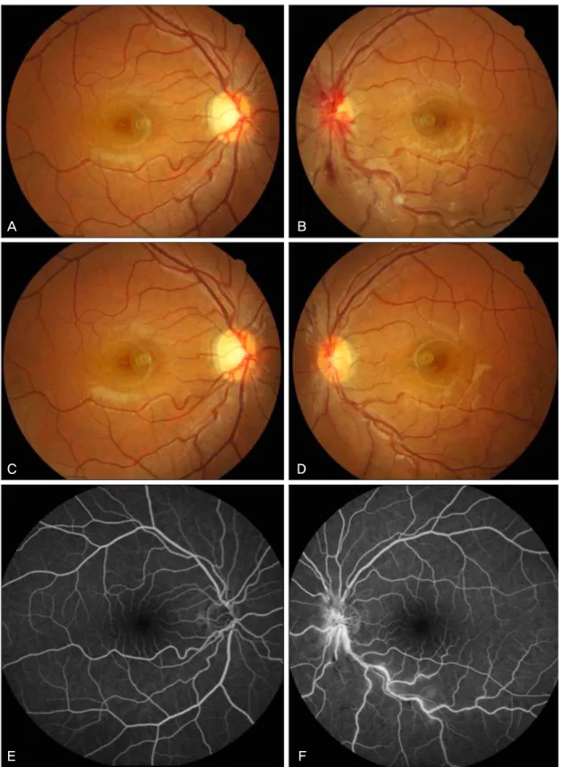 Figure 3. (A) A right eye fundus photograph, at the first visit, shows tortuous vascular change