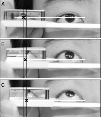 Table 1. Relative exophthalmometry according to various ocular measuring points (mm)
