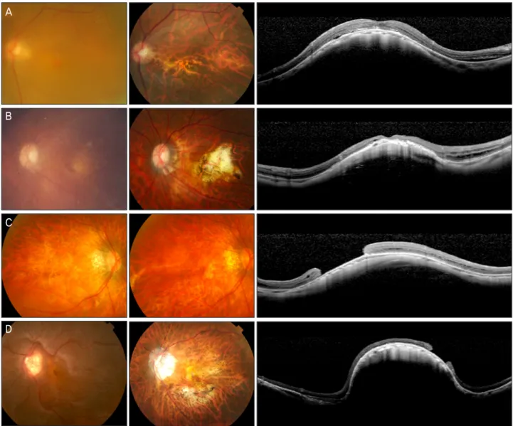 Figure 2. Pre and postoperative fundus photographs (left) and vertical optical coherence tomography (OCT) images through the  macula (right) of patients with myopic macular hole and retinal detachment after (A) 4 years, (B) 7 years, (C) 10 months, and (D) 