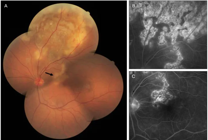 Figure 1. Case 1. Fundus photograph and fluorescein angiographs of the left eye at initial visit