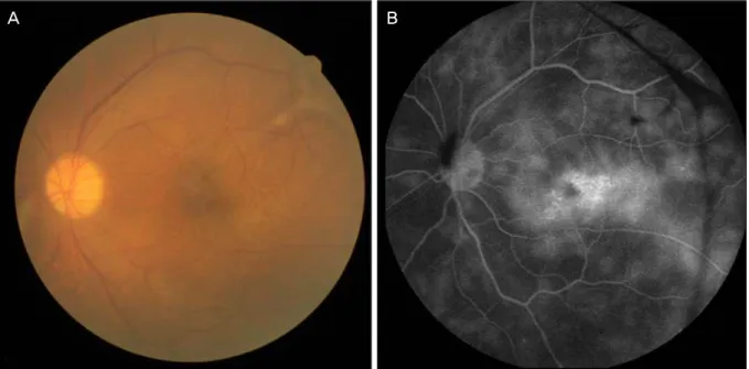 Figure 4. Case 2. Initial fundus photograph of the left eye shows vitreous opacity and a premacular membrane (A)