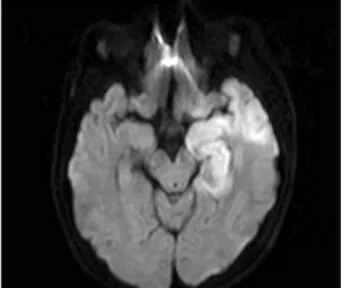 Figure 1. Brain MRI enhanced sequence consistent with le- le-sions of herpes simplex encephalitis.
