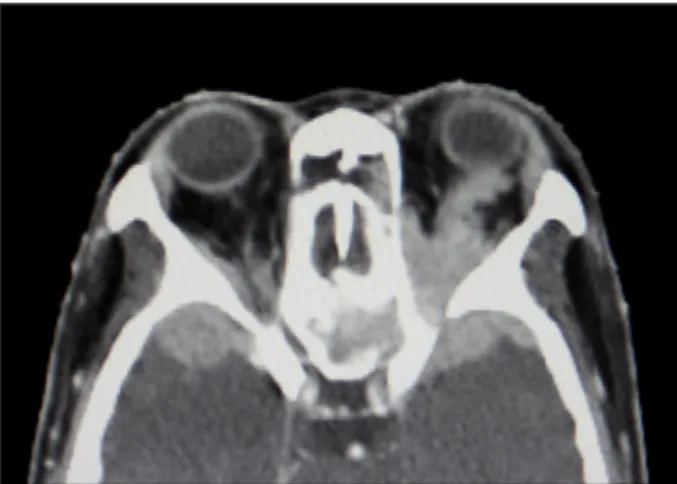 Figure 1. Axial CT scan demonstrating extensive mass involv- involv-ing both orbits, ethmoid sinus, and skull base.