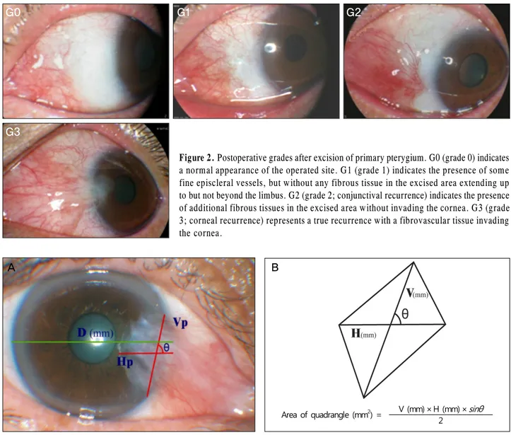 Figure 2. Postoperative grades after excision of primary pterygium. G0 (grade 0) indicates a normal appearance of the operated site