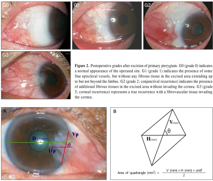 Figure 2. Postoperative grades after excision of primary pterygium. G0 (grade 0) indicates a normal appearance of the operated site