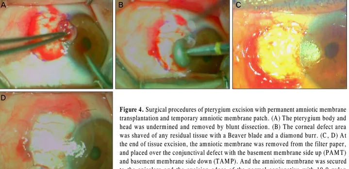Figure 4. Surgical procedures of pterygium excision with permanent amniotic membrane transplantation and temporary amniotic membrane patch
