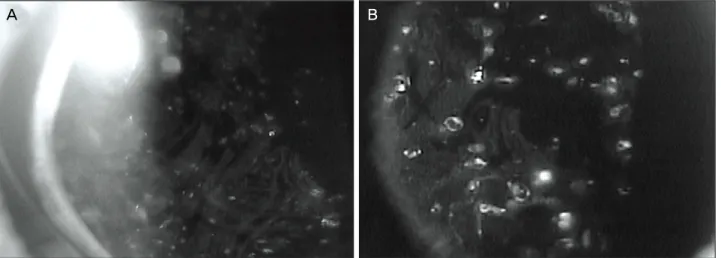 Figure 2. Greasy oil films with a wavy pattern were seen coating the anterior optic surface of the intraocular lens in case 1 (A) and  case 3 (B) at high magnification (×25)