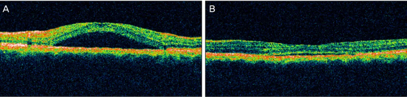 Figure 2. The baseline optical coherence tomography (OCT) of the left eye shows a neurosensory retinal detachment in the  macular region (A), OCT of the left eye at four weeks after focal laser photocoagulation shows resolution of neurosensory  reti-nal de