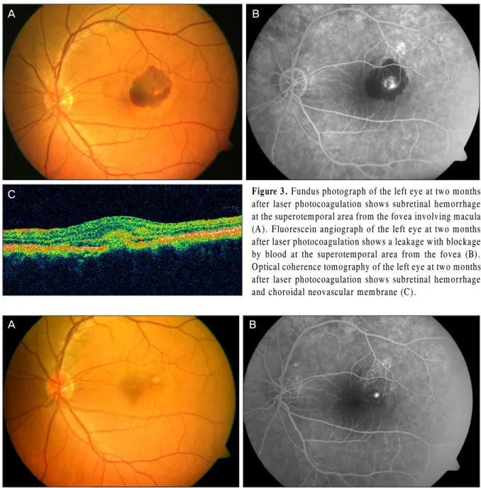 Figure 3. Fundus photograph of the left eye at two months  after laser photocoagulation shows subretinal hemorrhage  at the superotemporal area from the fovea involving macula  (A)