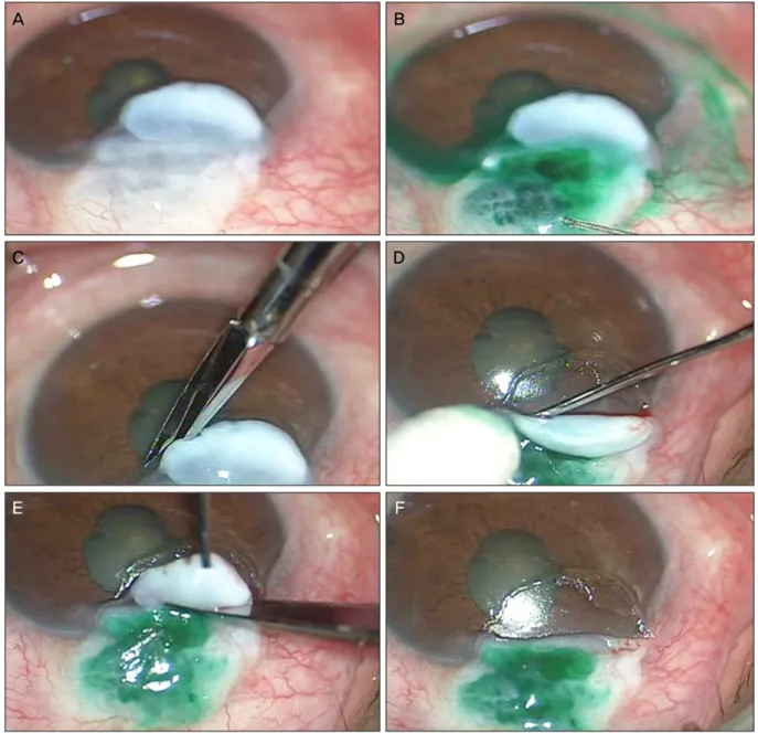 Figure 3. (A) Preoperative overhanging bleb. (B) ICG dye injection into the functioning bleb for separation from the  non-functioning bleb