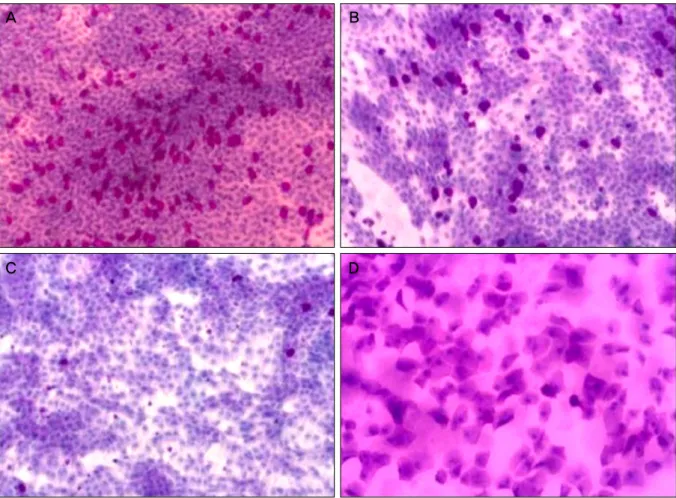 Figure 2. Impression cytologic finding of goblet cell density (PAS-H&amp;E, ×100). (A) Specimen from a patient of normal sub- sub-ject (Group A) shows a large amount of goblet cell density