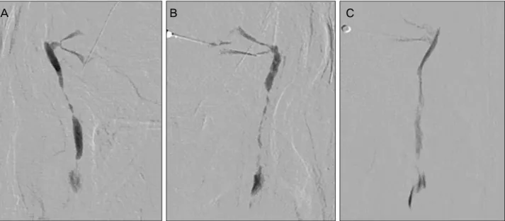 Figure 1. The upper and lower canaliculi can connect to the lacrimal sac by 3 different ways: (A) Type I is a common canaliculus