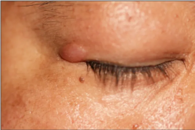 Figure 1. Preoperative appearance shows a reddish, well-de- well-de-marcated, oval shaped mass in the right upper eyelid.