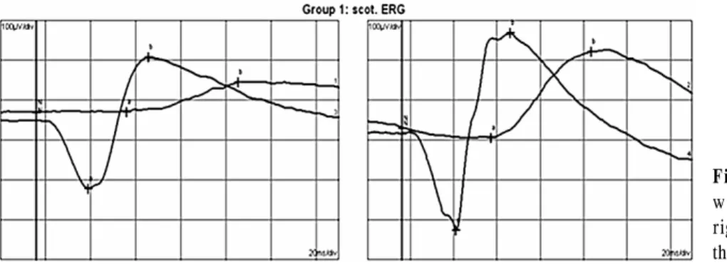 Figure 4. Electroretinogram shows a  wave and b wave amplitudes of the  right eye decreased more than those of  the left eye.