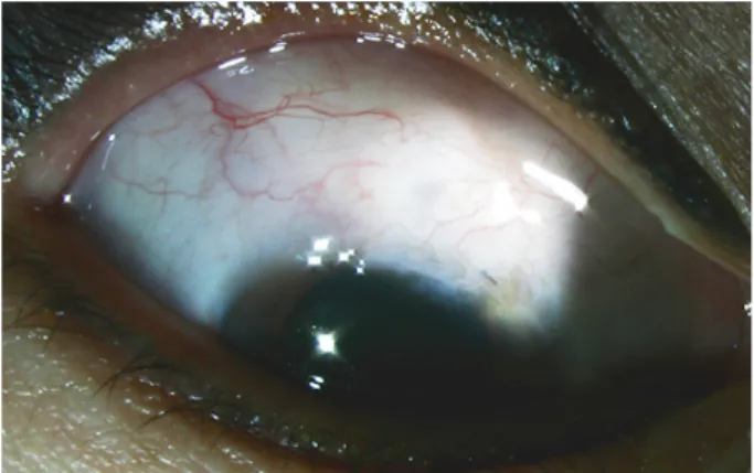 Figure 5. Slit lamp photography of the right eye shows well  elevated bleb with medium height, 4 clock hour horizontal  ex-tent and mild vascularity at 8 month after trabeculectomy with  mitomycin C.