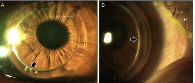 Figure 4. Inferior descent of the implanted ring segments (arrow) occurred at postoperative 2 months in Case 1 but the visual  acuity was not affected (A)