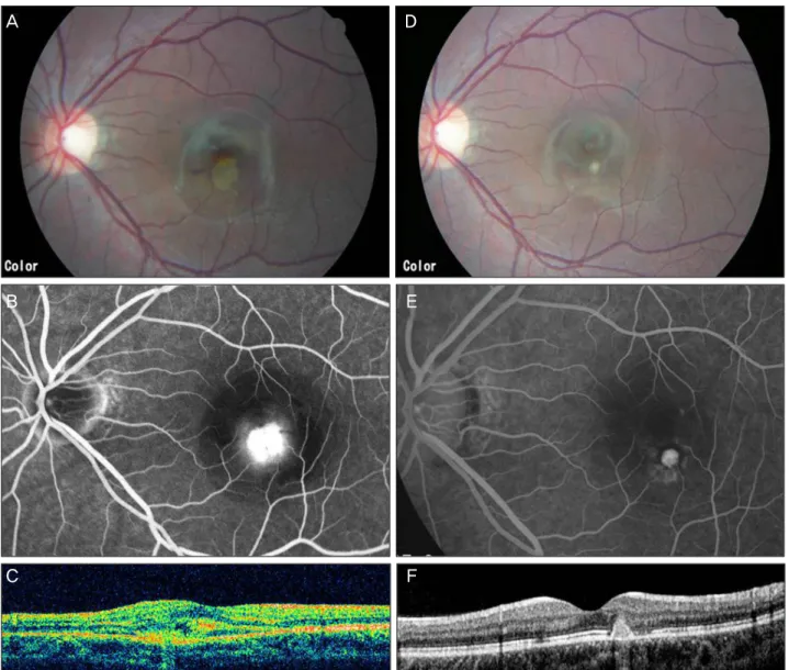 Figure 1. Left eye of 19-year-old woman in fixed regimen group treated by IVB. The refractive error was -8.5 D and initial best-cor- best-cor-rected visual acuity was 20/50
