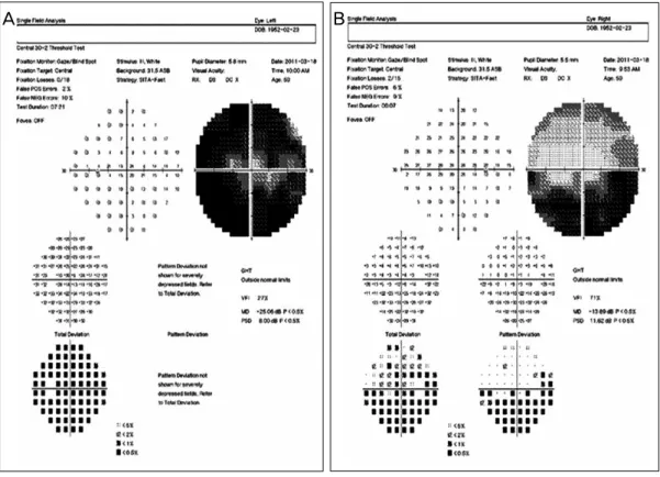 Figure 1. Humphrey visual field test reveals marked visual field defects in the left eye (A), and inferior  altitudinal visual field defects in the right eye (B).