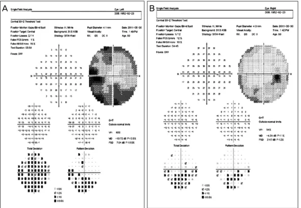 Figure 4. Two months after steroid therapy, there is significant improvement in the visual field defects of  both eyes (A, B).