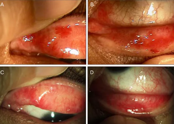 Figure 1. Anterior segment photograph before (A, B) and after (C, D) surgery. Flat papillomas on the  surface of the upper (A) and lower (B) tarsal conjunctiva before surgery