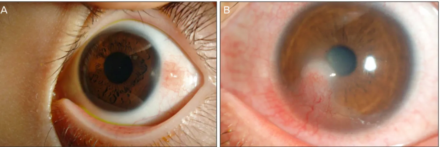 Figure 3. Representative cases of phlyctenular conjunctivitis (A) and keratitis (B). A whitish elevated lesion with neovascularization  from the conjunctiva across the limbus was a typical manifestation of phlyctenular keratitis (B).