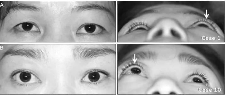 Figure 2. Eyelid photos of two patients showing proptosis resulting from ONSM. One patient (case 1) presented with proptosis of  the left eye (A, white arrow), and the other patient (case 10) showed proptosis of the right eye (B, white arrow).
