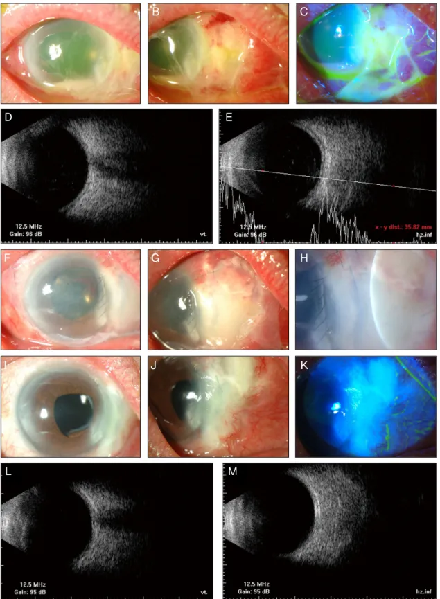 Figure 1. (A), (B), (C) The right eye at the first visit presented conjunctival injection, corneal edema, hypopyon, scleral  edema, necrosis and thinning in nasal sclera, and  epithelial defect in the nasal peripheral cornea