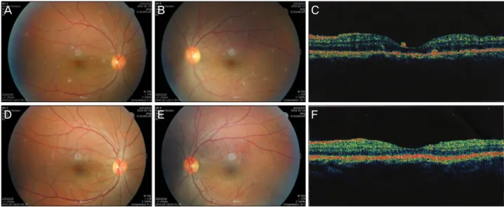 Figure 4.  ‘A’ and 'B' are the photographs of fundus about 1 week after antituberculous medication and systemic steroid therapy