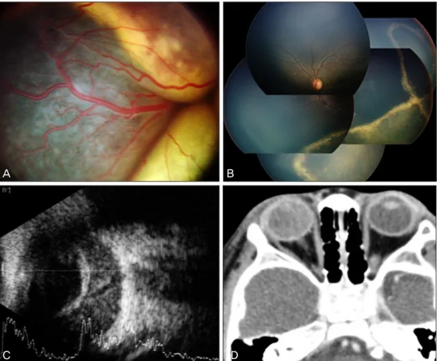 Figure 1. Initial examination findings. (A) Total bullous exudative retinal detatchment with retinal vascular te- te-langiectasia in the right eye