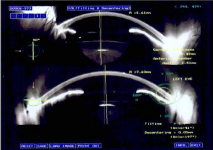 Figure 1. Measuring tilt and decentration of implantable col- col-lamer lens (ICL) based on Scheimpflug image.