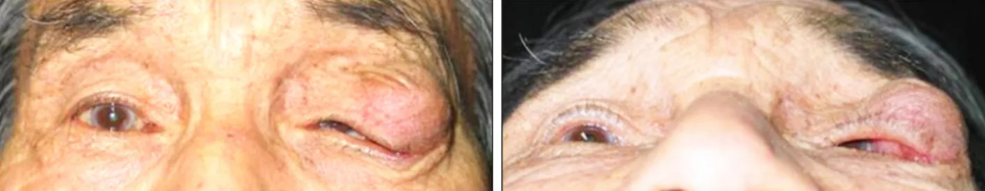 Figure 1. Photographs show a huge protruding upper lid mass causing severe mechanical ptosis.