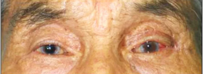 Figure 5. Photograph of the patient at postoperative 1 month  shows completely removed upper lid mass and resolved  pre-operative severe mechanical ptosis.