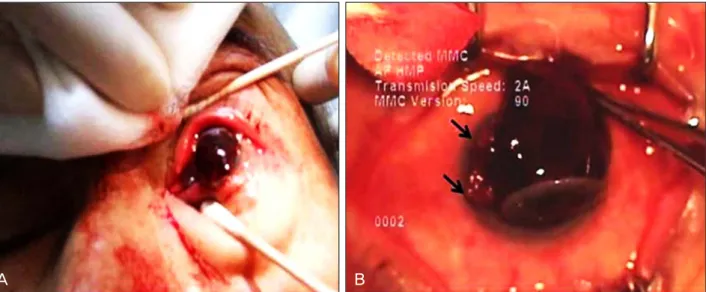 Figure 3. Ultrasound image and anterior segment photograph at postoperative one week.