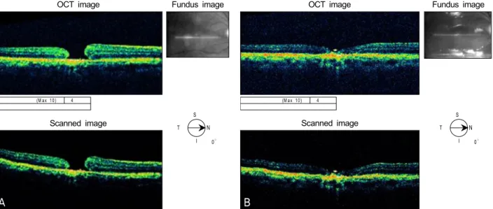 Figure 3. OCT (A) at 1 month after vitrectomy and C 3 F 8  gas infusion. Full-thickness defect of neurosensory retina is still noted