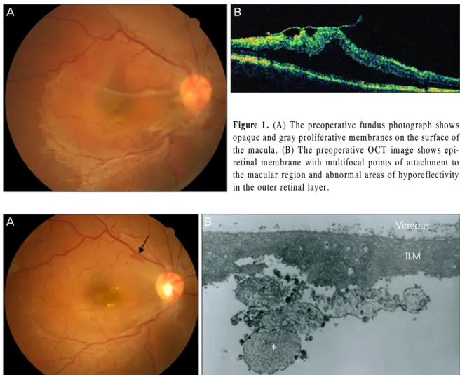 Figure 1. (A) The preoperative fundus photograph shows  opaque and gray proliferative membranes on the surface of  the macula