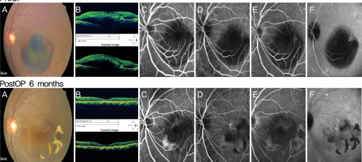 Figure 1. Case 1 pre-operation and post-operation fundus photograph, OCT, FAG and HRA
