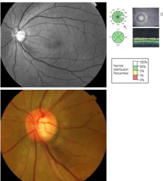Figure 1. Example of false negative finding. Inferior localized  retinal nerve fiber layer defect was observed on the red-free  photograph, but optical coherence tomography result was  nor-mal at the corresponding location on the sector average  analysis.