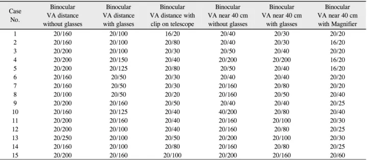 Table 2. Visual acuity results with low vision devices Case No. Binocular VA distance without glasses Binocular VA distancewith glasses Binocular  VA distance with clip on telescope Binocular VA near 40 cmwithout glasses Binocular VA near 40 cmwith glasses