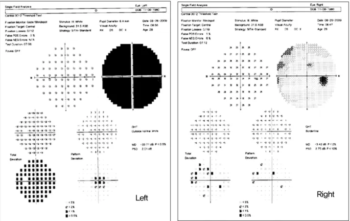 Figure 3. Humphrey static perimetry reveals marked visual field defect in the left eye, and normal in the right eye.
