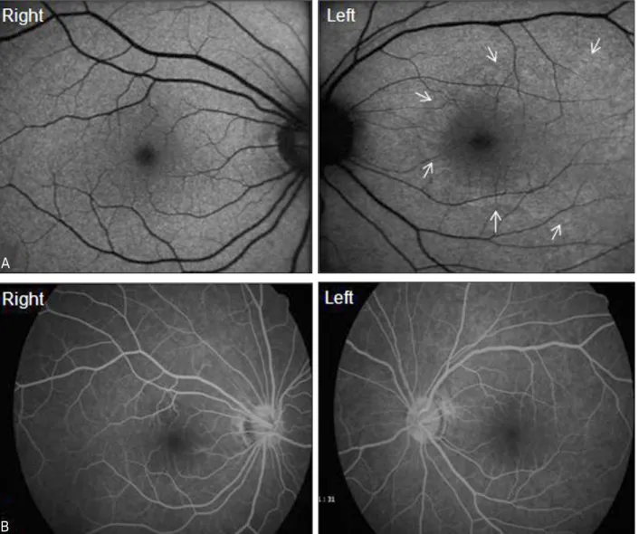 Figure 4. (A) Fundus autofluorescence show ill-defined hyperautofluorescent area at the posterior pole in the left eye (arrows) and  normal in the right eye at the initial visit