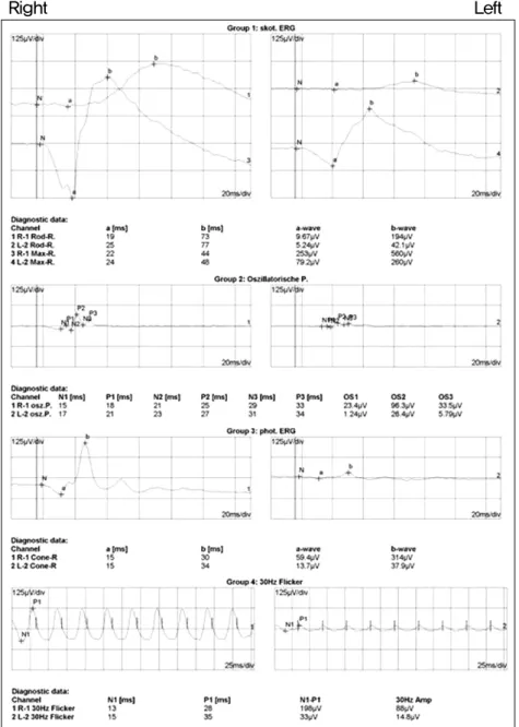 Figure 5. Electroretinographic findings show normal in the right eye, abnormal in the left  eye; subnormal rod specific ERG, both  a-wave and b-wave amplitude reduction in  maximal response, subnormal photopic  sin-gle flash b-wave amplitude, and markedly 