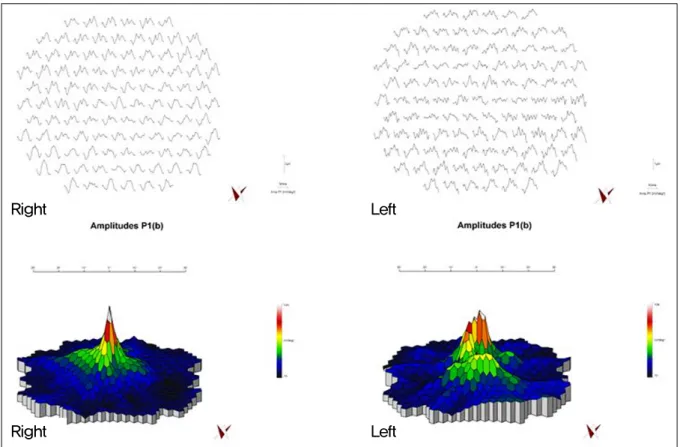 Figure 6. Trace array and topographic maps of multifocal ERG show markedly reduced responses in the left eye and normal  in the right eye.