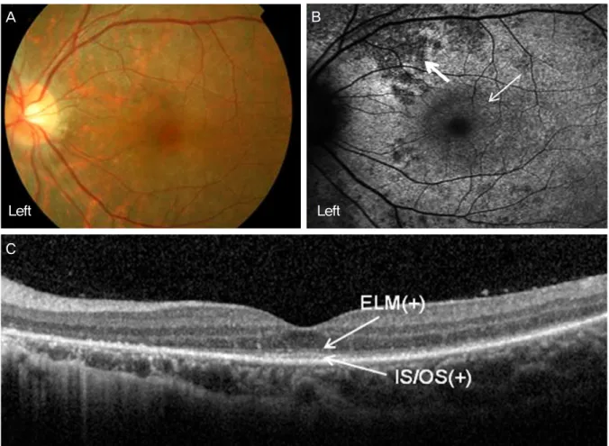 Figure 9. Findings at 10 months after the initial visit. (A) Fundus photography shows normal in the left eye