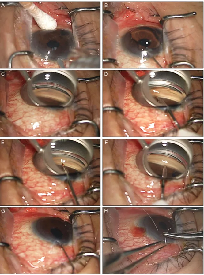 Figure 1. Trabectome surgical steps. (A) Create a 1.6-mm clear corneal incision. (B) Inject a small amount of viscoelastic  at the incision site